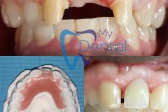 Single Tooth Denture
