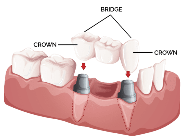 crowns & bridges