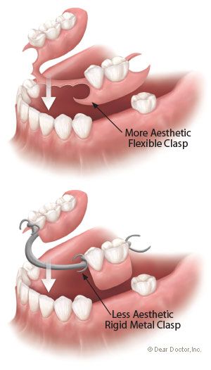 partial dentures