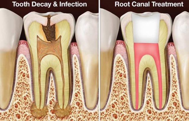 root canal treatment