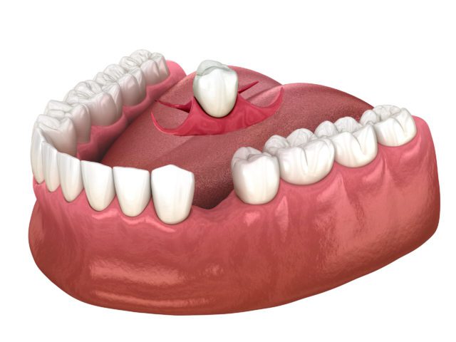 immediate denture