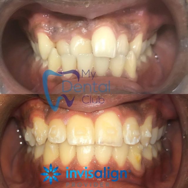 invisalign dentist , cosmetic dentist , trinidad dentist